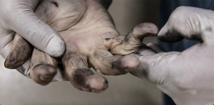 A murder victim in Denmark being fingerprinted during an autopsy